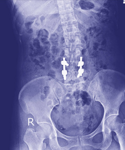 骨盆和脊柱的 X 线, 侧视后切开复位内固定与内骨骼棒, 钢板和螺钉的矫形外科医生