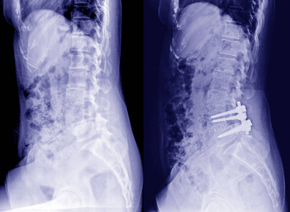 骨盆和脊柱的 X 线, 侧视后切开复位内固定与内骨骼棒, 钢板和螺钉的矫形外科医生