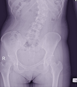 脊柱侧凸片 x 线显示青少年患者脊柱弯曲。脊柱侧凸病
