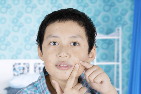 青春期问题关闭一个亚洲青春期男孩有问题的脸, 而在他的脸上的粉刺.