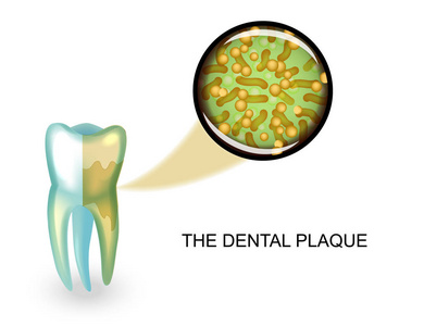 牙菌斑。微生物在放大倍率下