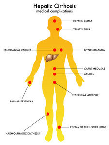 肝硬化患者