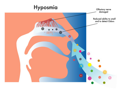 症状的 hyposmia 医学插图