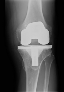 bicompartmental 膝关节假体 x 射线
