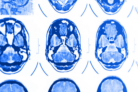 ct 和 mri 的头骨