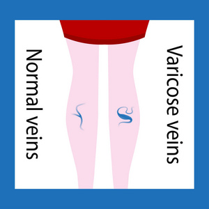 矢量曲张静脉和正常静脉。苗条和漂亮的女性双腿。曲张静脉