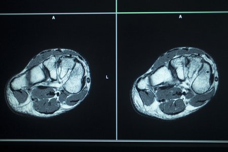 Mri 扫描测试结果脚脚趾伤