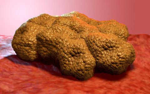 癌症肿瘤癌症肿瘤,3d 医学插图照片