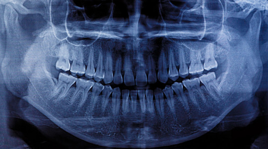 牙齿的 x 光扫描照片