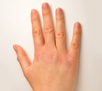 有碍观瞻干枯的手由寒冷的天气照片