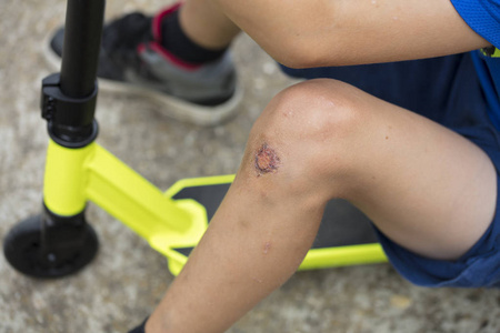擦伤的膝盖的孩子。男孩腿受伤期间骑滑板车。孩子们的安全，使用保护膝盖垫概念