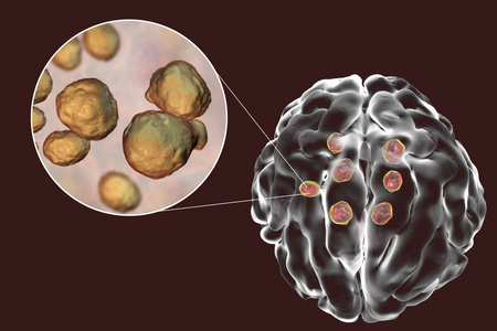 大脑中的多个新型隐球菌性囊肿图片