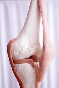 人体膝关节半月板损伤模型照片