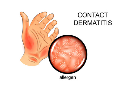 在皮肤上的过敏原。过敏，皮肤病学