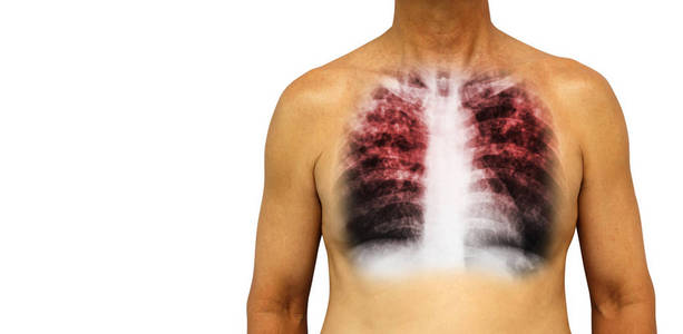 肺结核。人的胸部 x 线显示间质浸润两肺感染所致。孤立的背景。在左侧的空白区域
