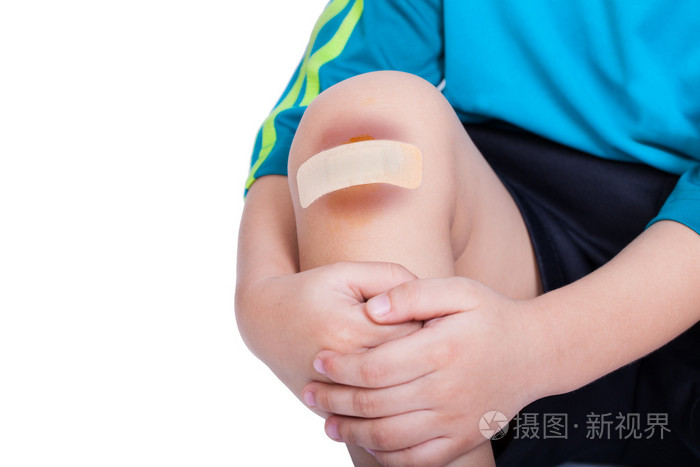 儿童膝盖与石膏 (为创伤) 和瘀伤