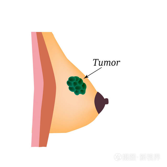 插画 乳腺组织中的肿瘤.世界乳腺癌癌症日.对孤立背景矢量图.eps