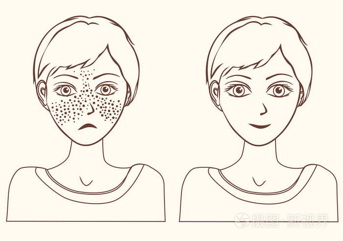 女孩的概念去除雀斑大纲插画-正版商用图片0vaxja-摄图新视界