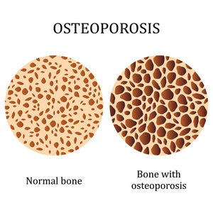健康的骨骼和骨质疏松症骨
