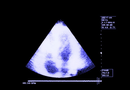 心脏超音波的背景和纹理