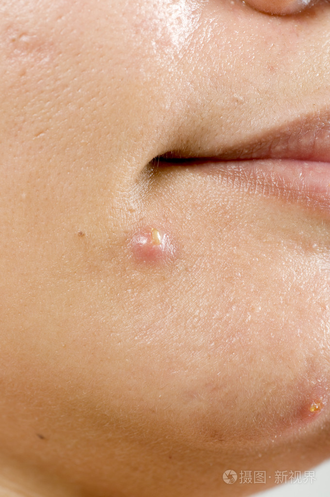 脸上的痘痘