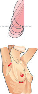 乳房整形手术