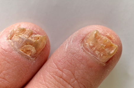 趾甲真菌感染的高峰期照片