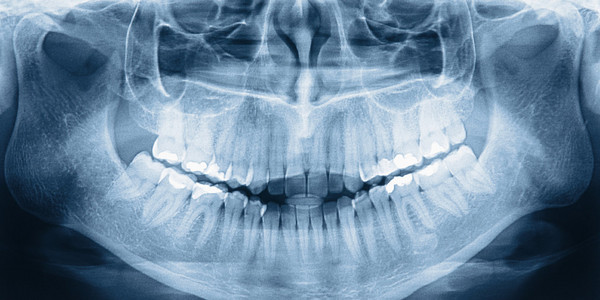 牙齿的 x 光扫描
