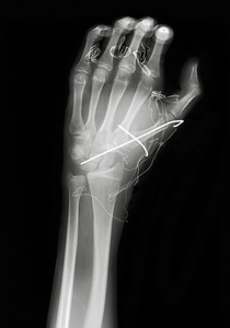 x 射线图像的手