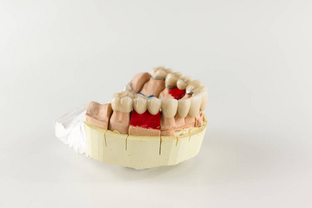 义齿基托制成的陶瓷位于石膏模型