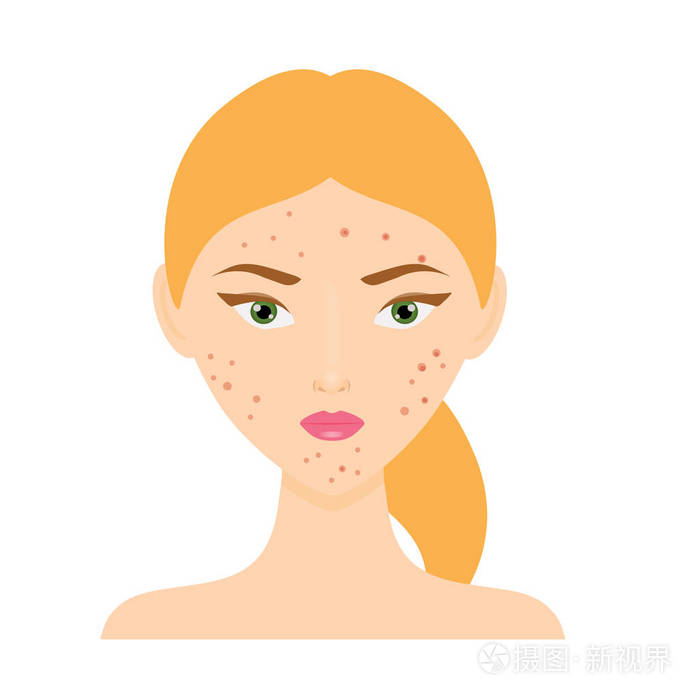 痤疮皮肤问题脸的女人矢量图