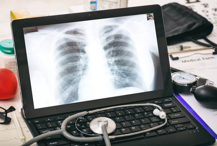 胸部 x 射线在医生的电脑屏幕上