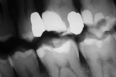 补牙牙科 x 射线