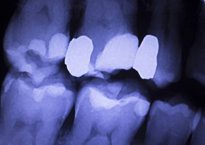 补牙牙科 x 射线