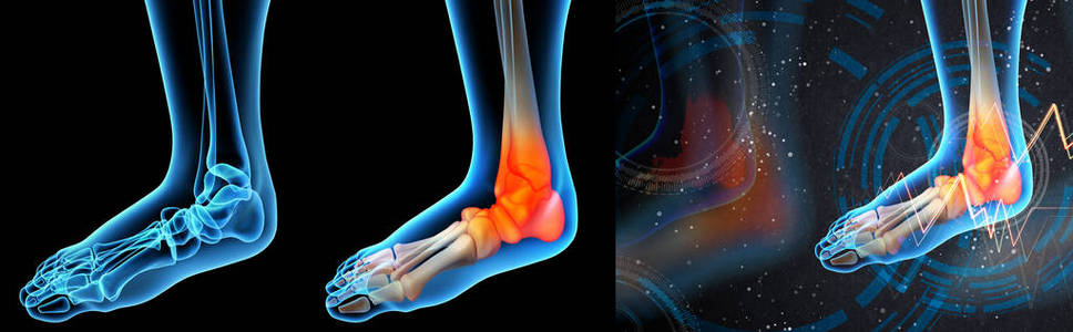 踝关节疼痛三维渲染图照片