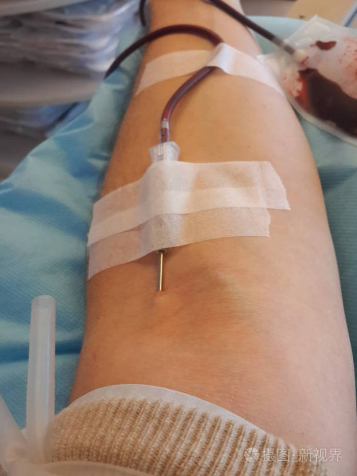一个成年男子的胳膊献血时用针