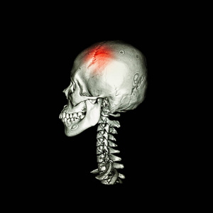 脑卒。以 3d 图像的人类头骨和颈椎 ct 扫描。横向视图