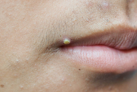 激素痘口大疙瘩照片