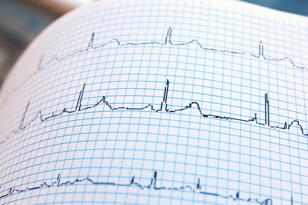 以纸张形式的心电图