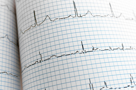 以纸张形式的心电图