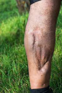 腿部受伤,从汽车或摩托车事故的旧伤疤照片