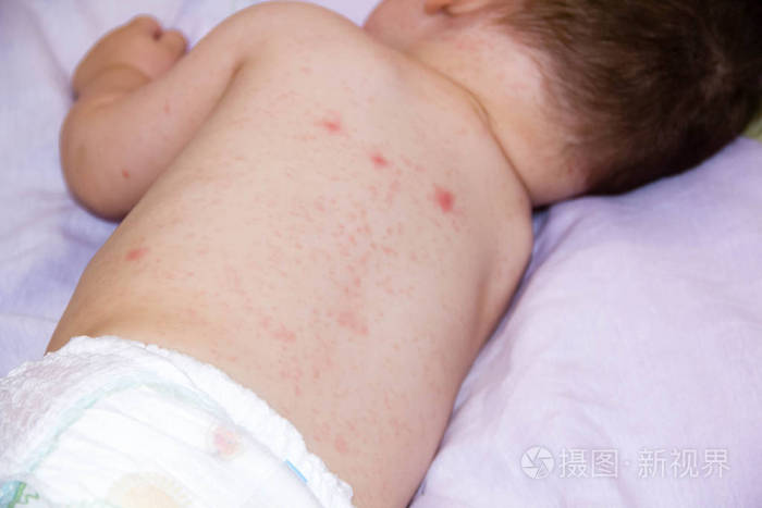 过敏婴儿皮肤皮炎食品。儿童皮炎症状问题皮疹。睡觉新生儿的脸。患过敏性症状在皮肤的脸颊上。概念儿童