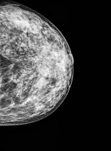 乳房 x 线钼靶摄影