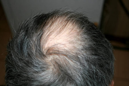 m发际线一个人的秃头.退去的发际线照片