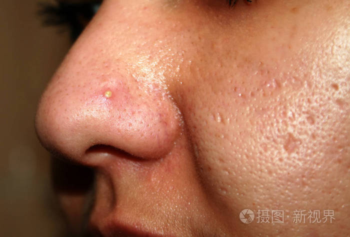鼻子上的发炎的丘疹油性的面部皮肤痤疮瘢痕疙瘩疤痕痤疮