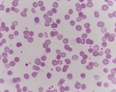 异常血红细胞照片
