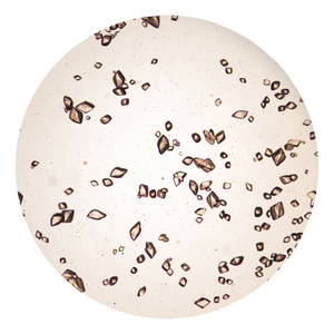 尿沉渣中的尿酸晶体照片