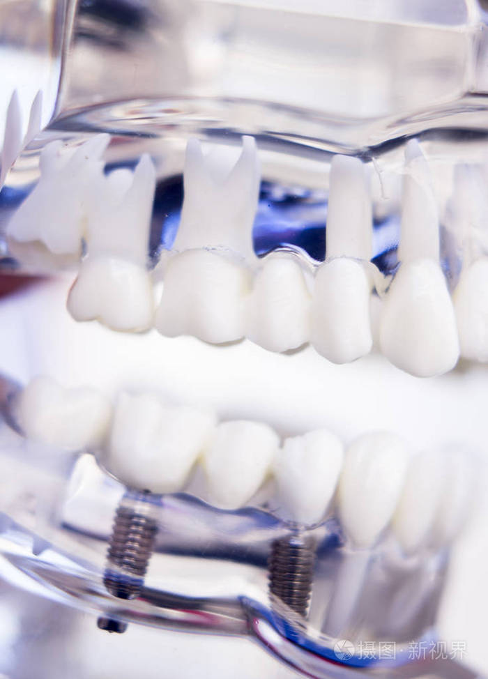 牙医牙科牙齿植入物
