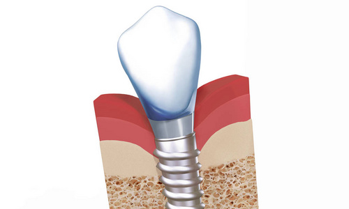 种植体与桥台和冠图片