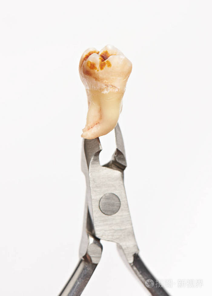 拔牙的特写照片-正版商用图片0wkglg-摄图新视界